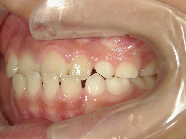青山アール矯正歯科 難波院-症例3-術3