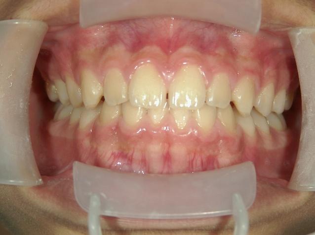 青山アール矯正歯科 難波院-症例3-術後1