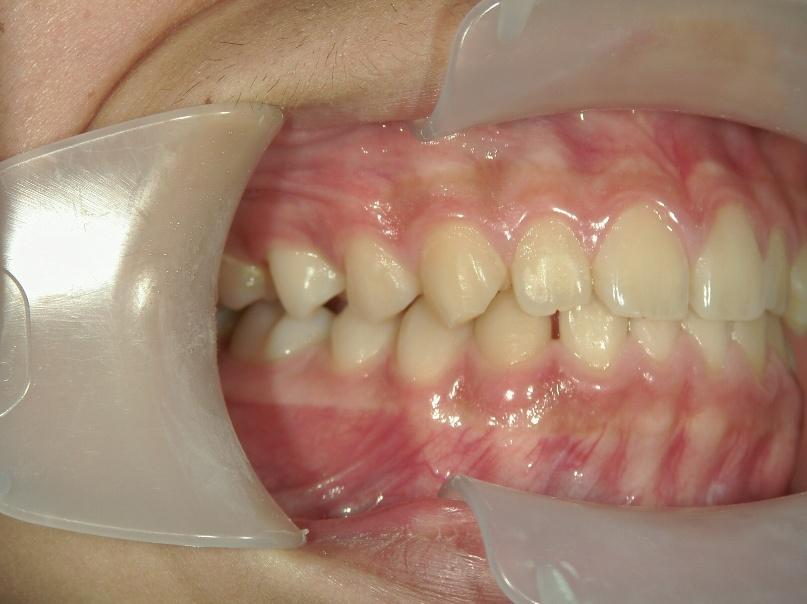 青山アール矯正歯科 難波院-症例3-術後2