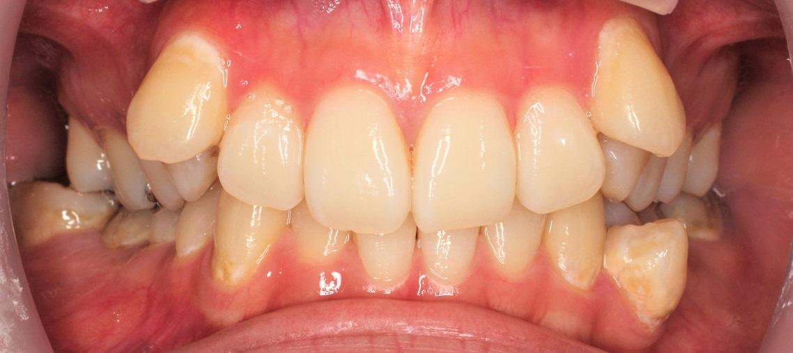青山アール矯正歯科 難波院-症例2-術前1
