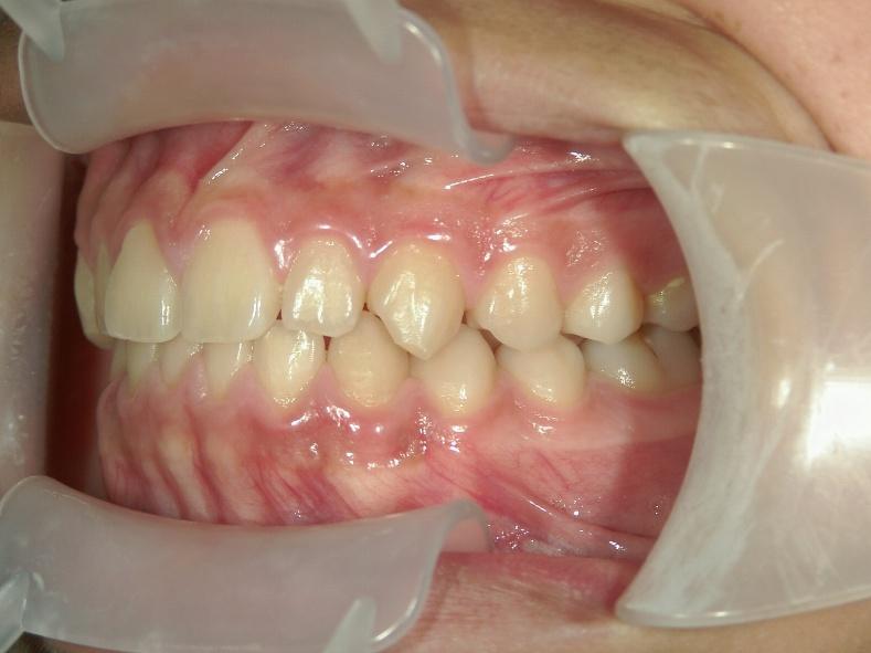 青山アール矯正歯科 難波院-症例3-術後3