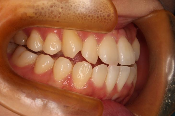 青山アール矯正歯科 難波院-症例4-術前1