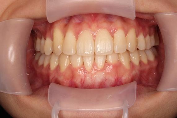青山アール矯正歯科 難波院-症例4-術後1