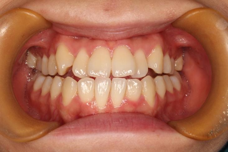 青山アール矯正歯科 難波院-症例4-術前2