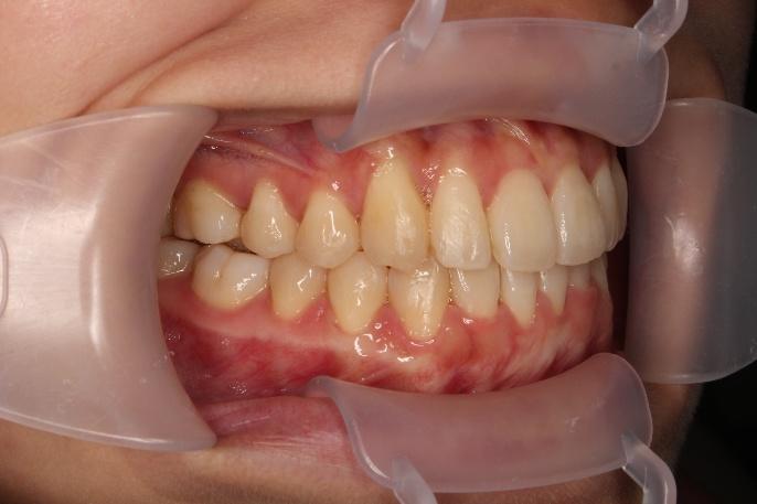 青山アール矯正歯科 難波院-症例4-術後2