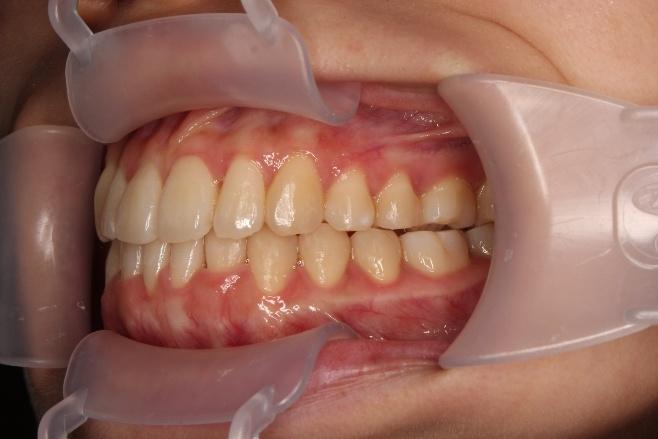 青山アール矯正歯科 難波院-症例4-術後3