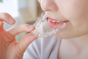 インビザラインがゆるくなる原因は？対処法や治療がやり直しになるケースを解説