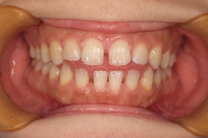 青山アール矯正歯科 難波院-症例5-術前1