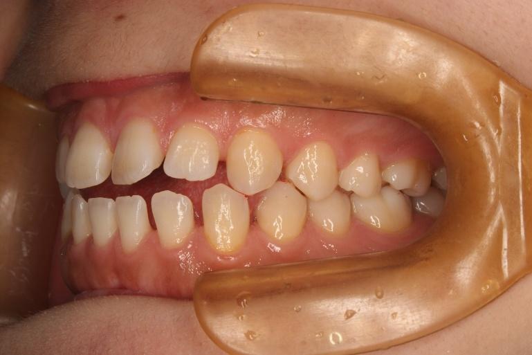 青山アール矯正歯科 難波院-症例5-術前2