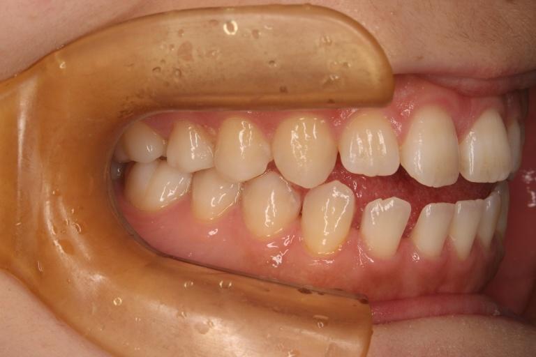 青山アール矯正歯科 難波院-症例5-術前3