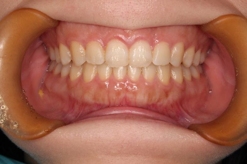 青山アール矯正歯科 難波院-症例5-術後1