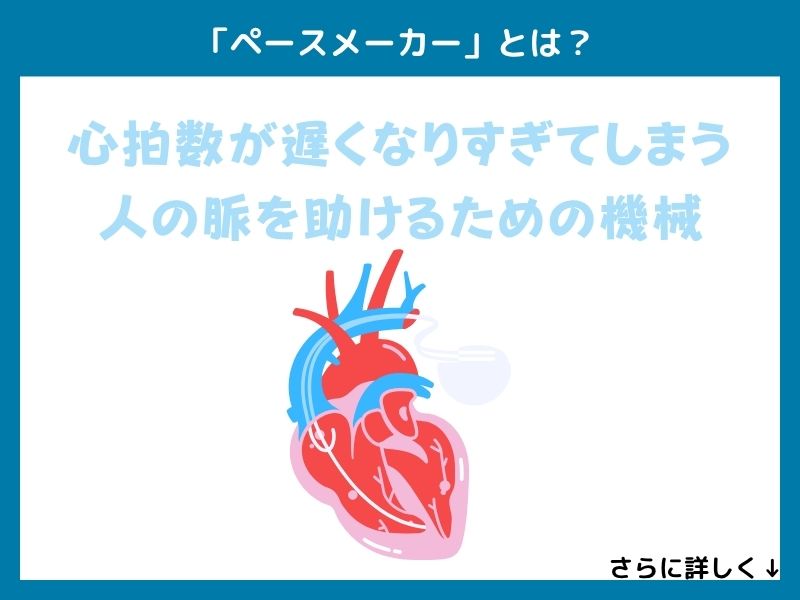 「ペースメーカー」とは？