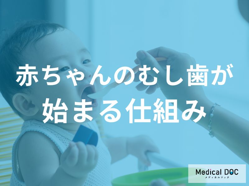 「赤ちゃんのむし歯」が発生してしまうのはなぜ？むし歯ができる仕組みを解説！