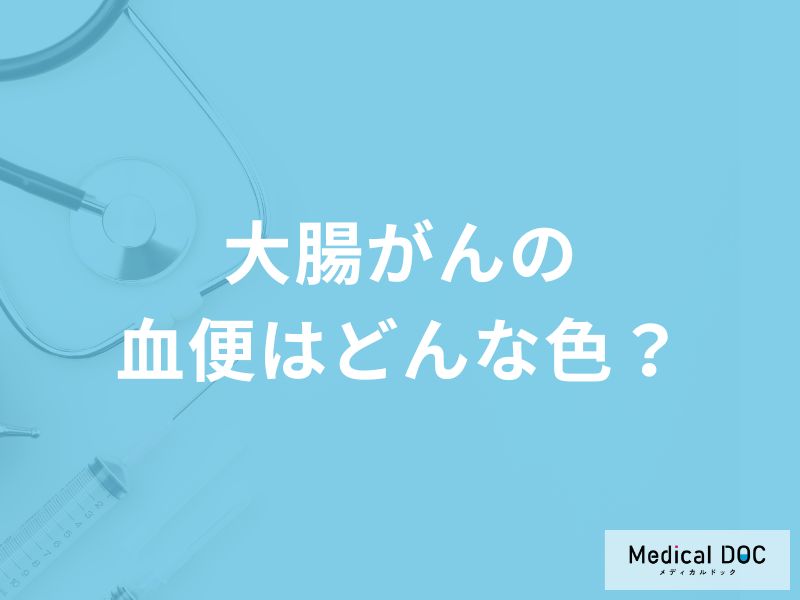 「大腸がんの血便」はどんな色かご存知ですか?医師が徹底解説!