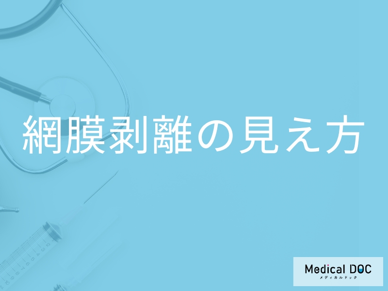 「網膜剝離」を発症するとどんな「見え方」になるかご存知ですか？初期の見え方も解説！