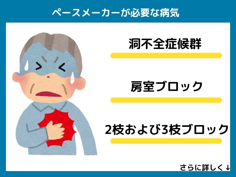 どんな病気に罹患するとペースメーカーが必要になる？