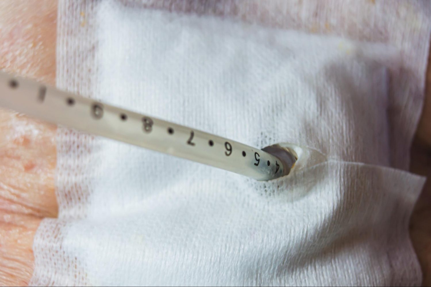 胃ろうでよくあるトラブル