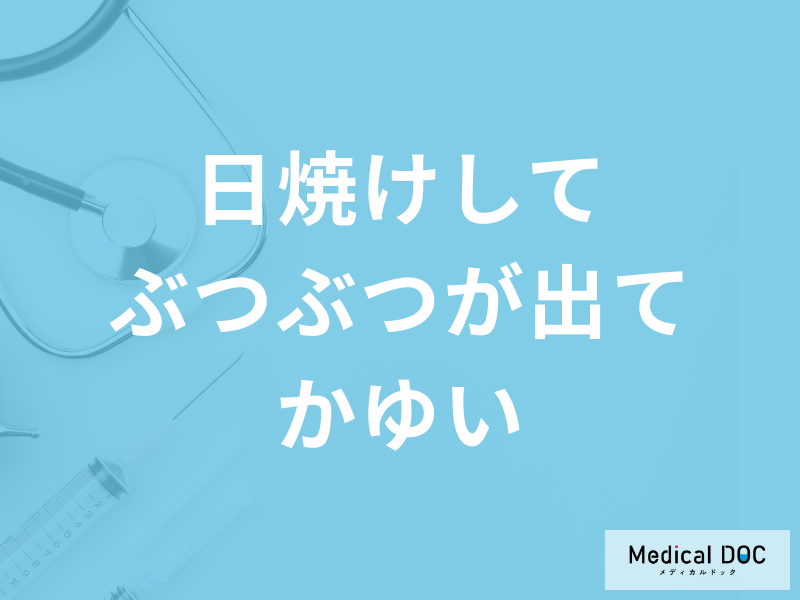 「日焼けしてぶつぶつが出てかゆい」ときの対処法は?日焼け止めについても解説!