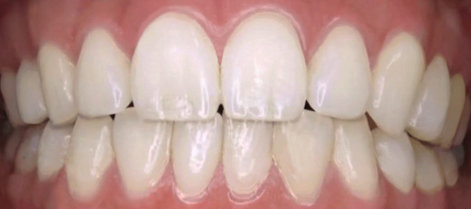 よい歯並びの基準と悪い歯並びの例