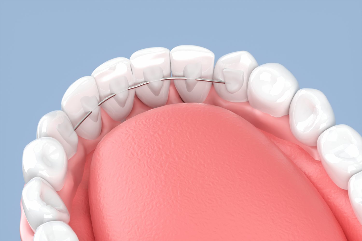 部分矯正の種類