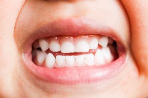 反対咬合（受け口）は自然に治らない？原因と放置するリスク、歯列矯正などの治療方法も解説