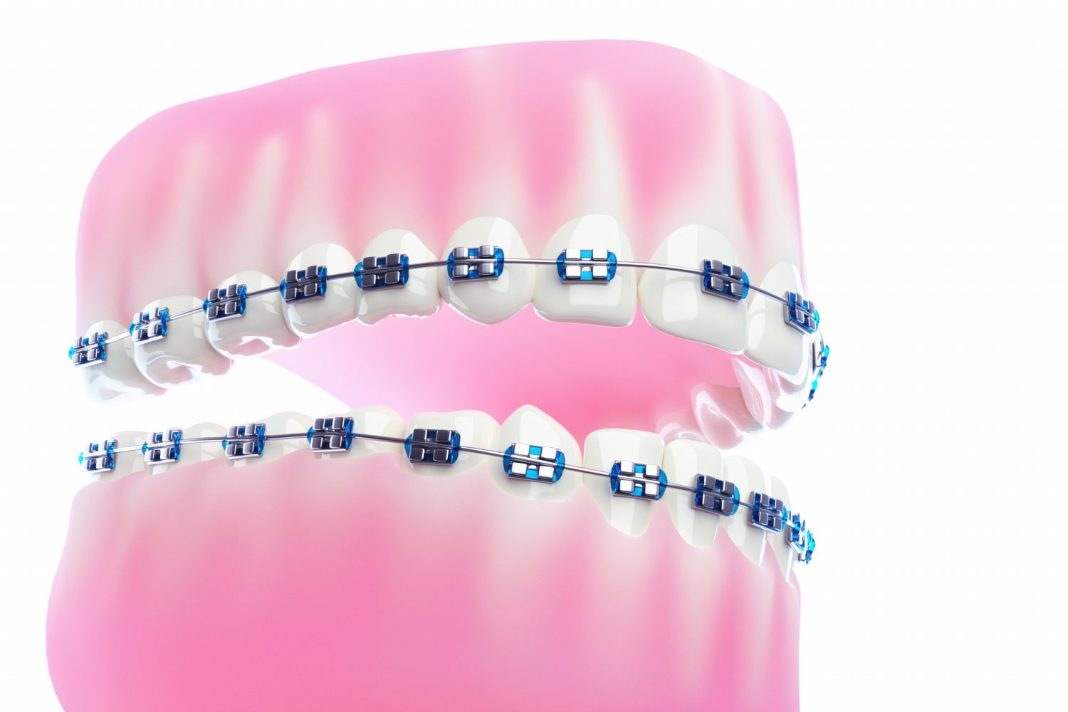 併用する歯列矯正の種類