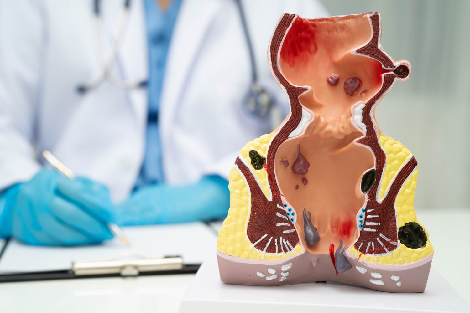 痔の治療法を教えて