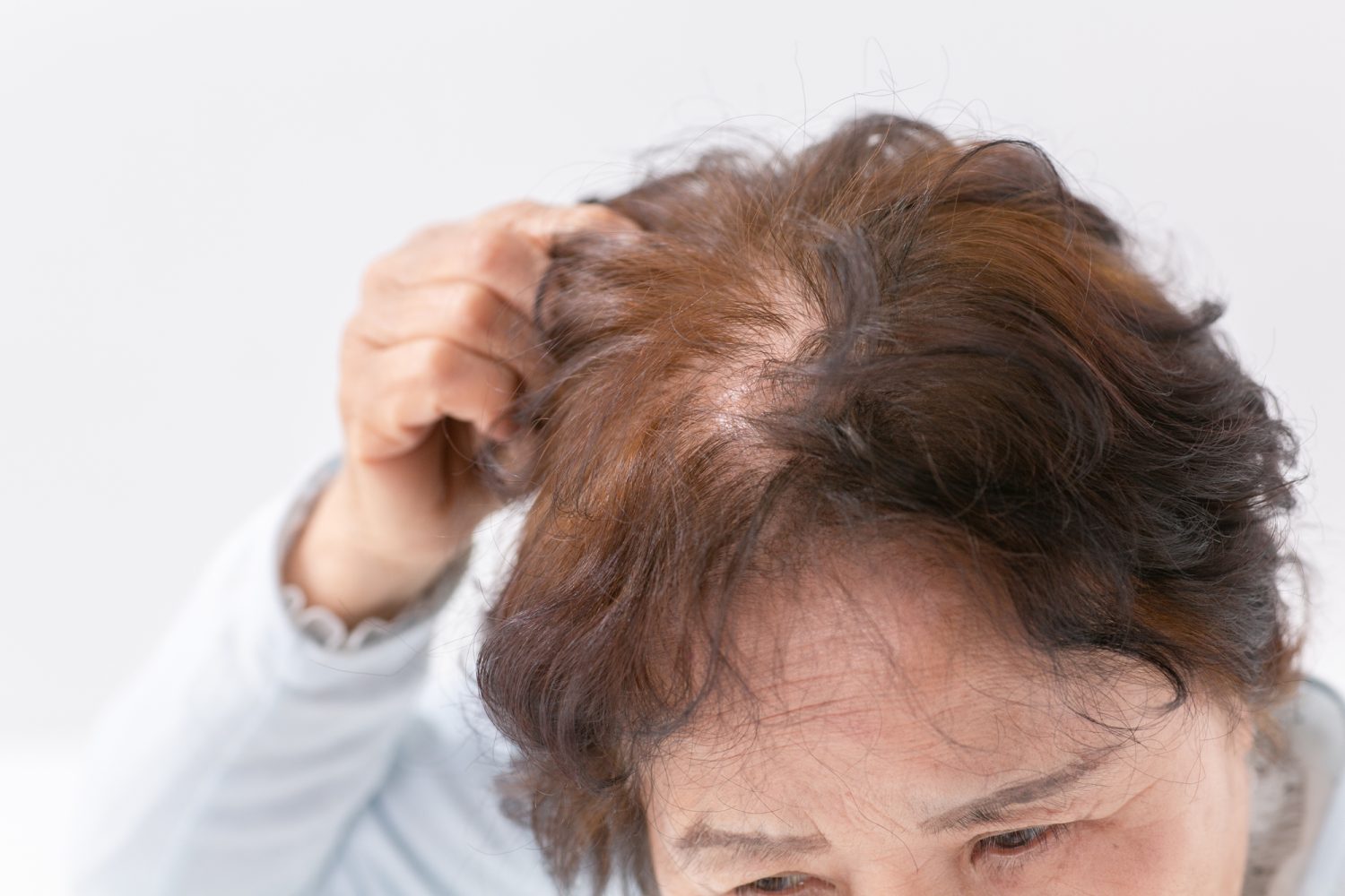 女性型脱毛症（FPHL／FAGA）って？男性の薄毛とは違うの？