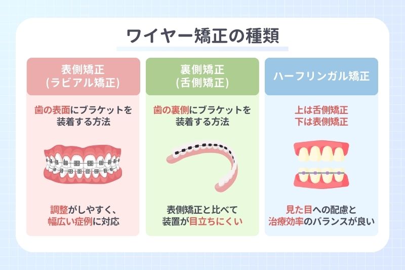 ワイヤー矯正の種類