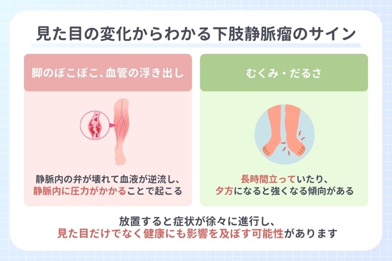 見逃しやすい初期症状!見た目の変化からわかる下肢静脈瘤のサイン