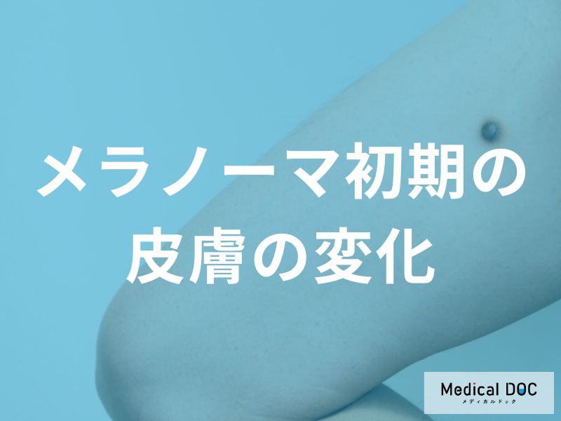 痛みがなくても要注意！メラノーマの初期症状と皮膚科を受診すべきサイン