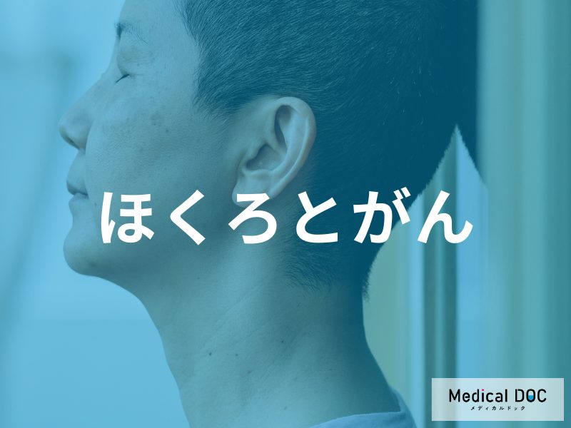 ほくろとがんの関係