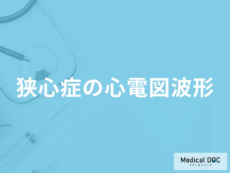 「狭心症」を疑う「心電図の波形」にはどんな特徴がある？【医師解説】