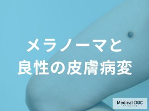 メラノーマと間違えやすい「シミ」や「いぼ」。良性病変との違いを医師が解説