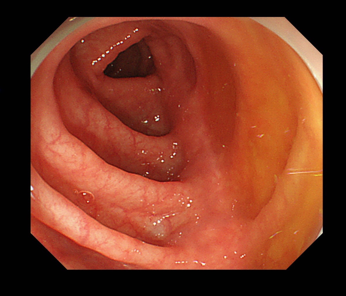 大腸カメラについて医師が解説！