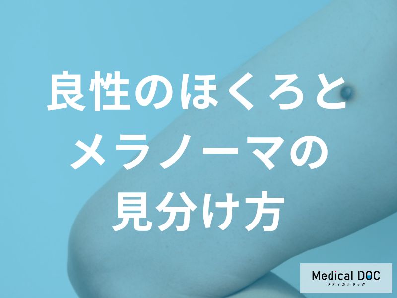 「良いほくろ」と「悪いほくろ」の違いは？自分で確認できる5つのポイント