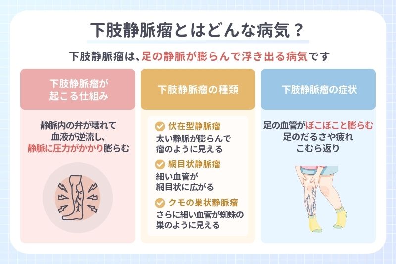下肢静脈瘤とはどんな病気?
