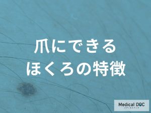 爪にできるほくろの特徴