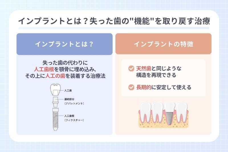 インプラントとは？失った歯の機能を取り戻す治療