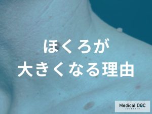 ほくろが大きくなる理由