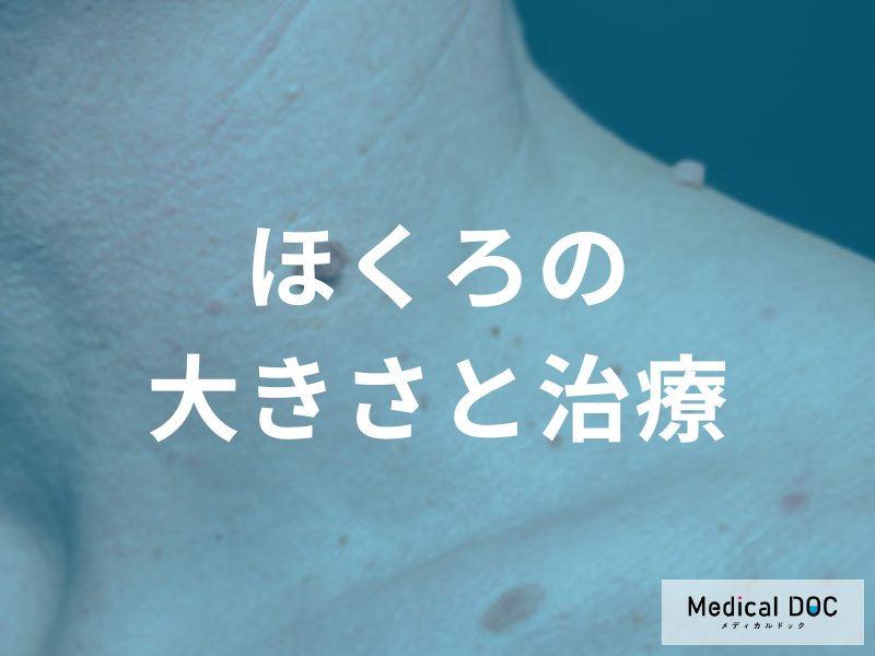 ほくろの大きさと治療の必要性