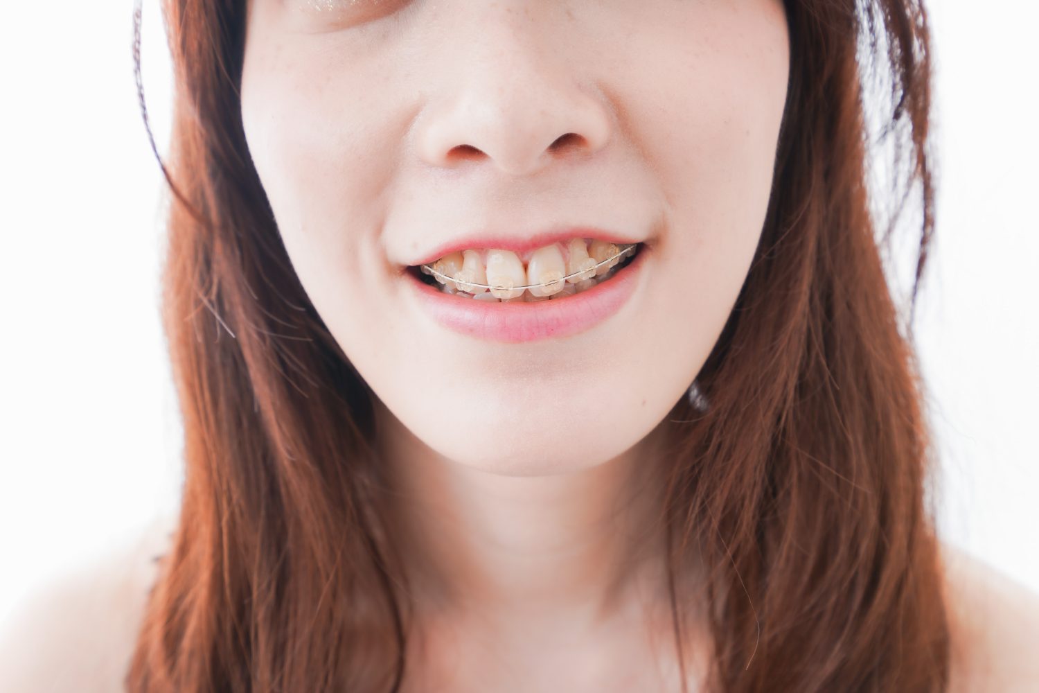 出っ歯の原因と症状