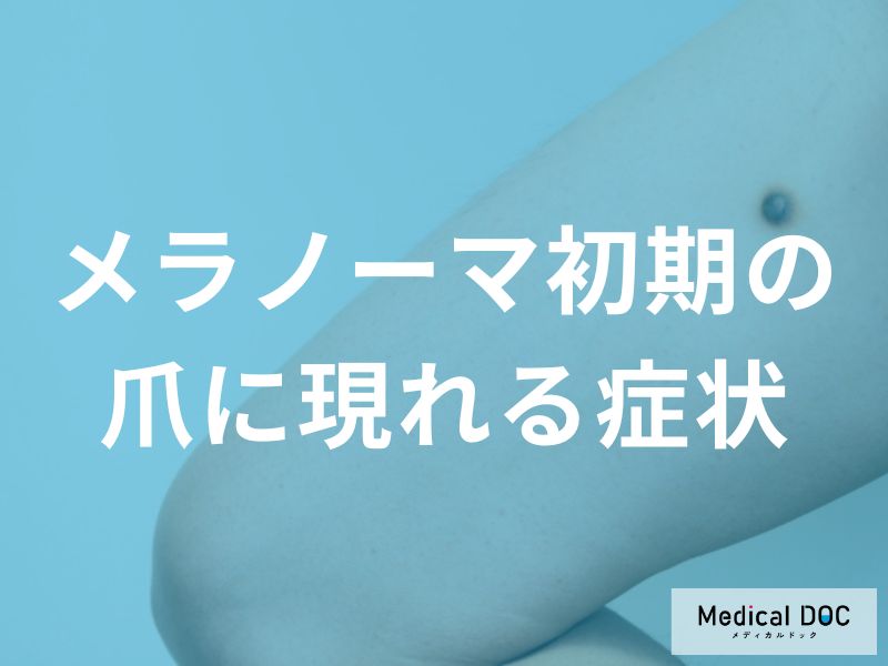 爪に黒い線ができたら要注意！メラノーマを見分けるポイントと受診目安