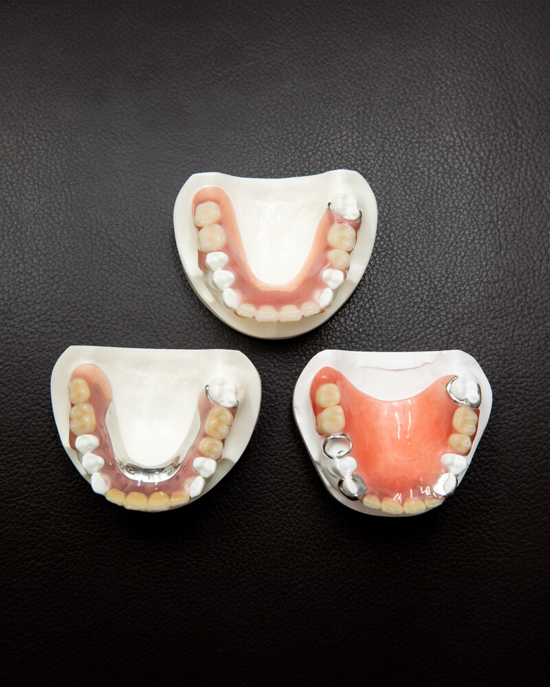 画期的な構造で審美性と機能性を両立させたミラクルデンチャー