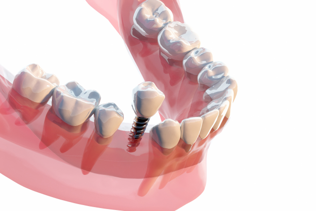 インプラントが難しい症例とは？対応方法や失敗を防ぐポイントを解説！