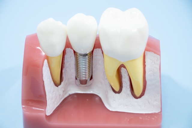 サイナスリフトで骨移植が必要になる理由