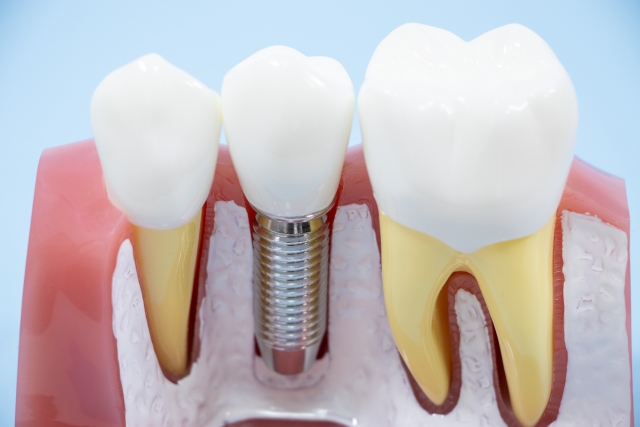 インプラント治療における歯科用CT検査の役割