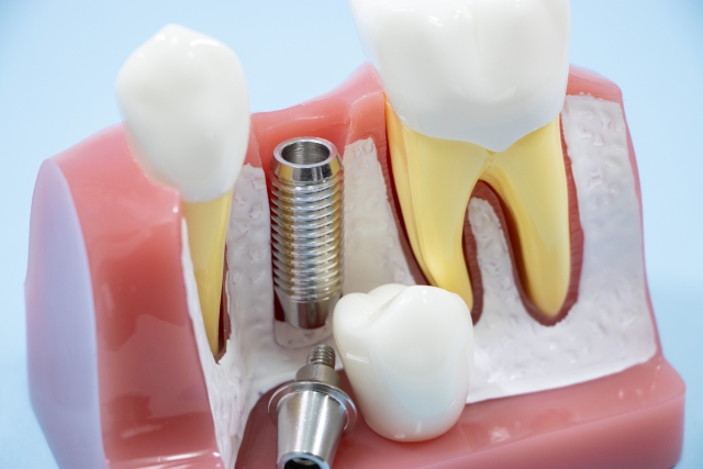インプラントの耐久性や寿命について