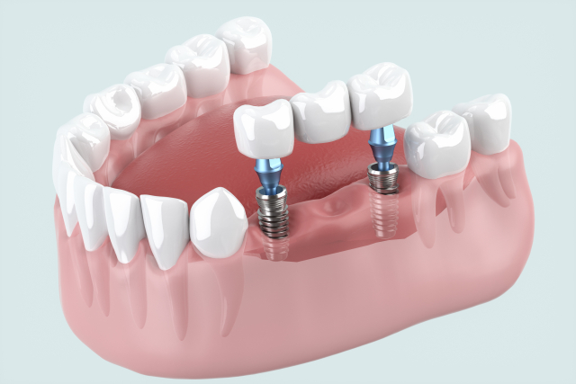 インプラント4本ブリッジとは