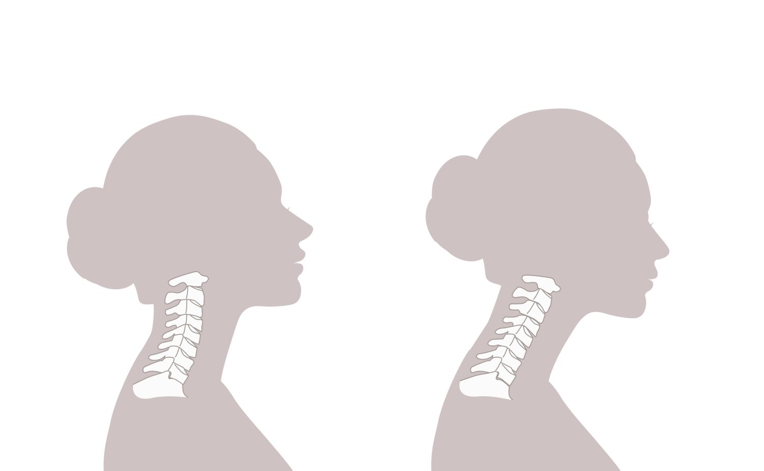 「スマホ首」ってどんな状態？ 首や肩の痛み・姿勢との関係
